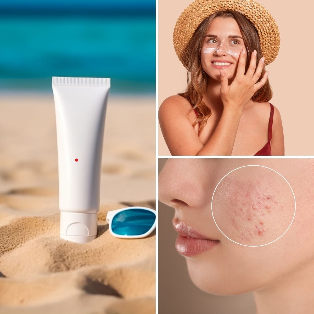 The Best Sunscreen for Acne-Prone Skin